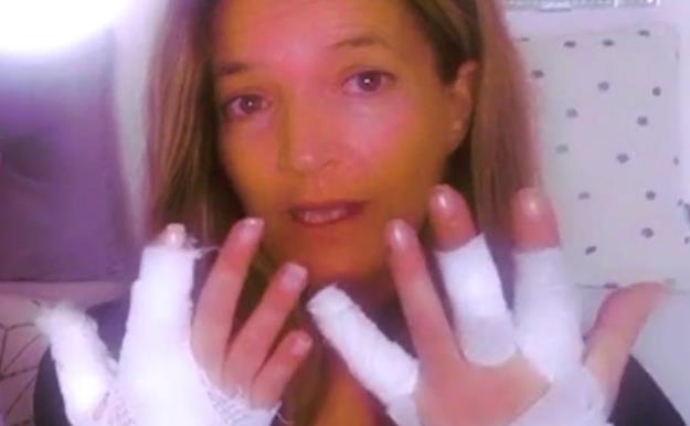 Raquel, de Las Mellis, sufre quemaduras de segundo grado por un accidente doméstico
