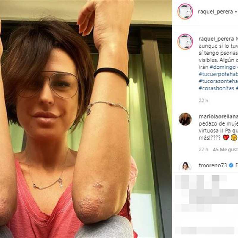 Raquel Perera enseña sus codos con psoriasis:  "Heridas de guerra visibles" 
