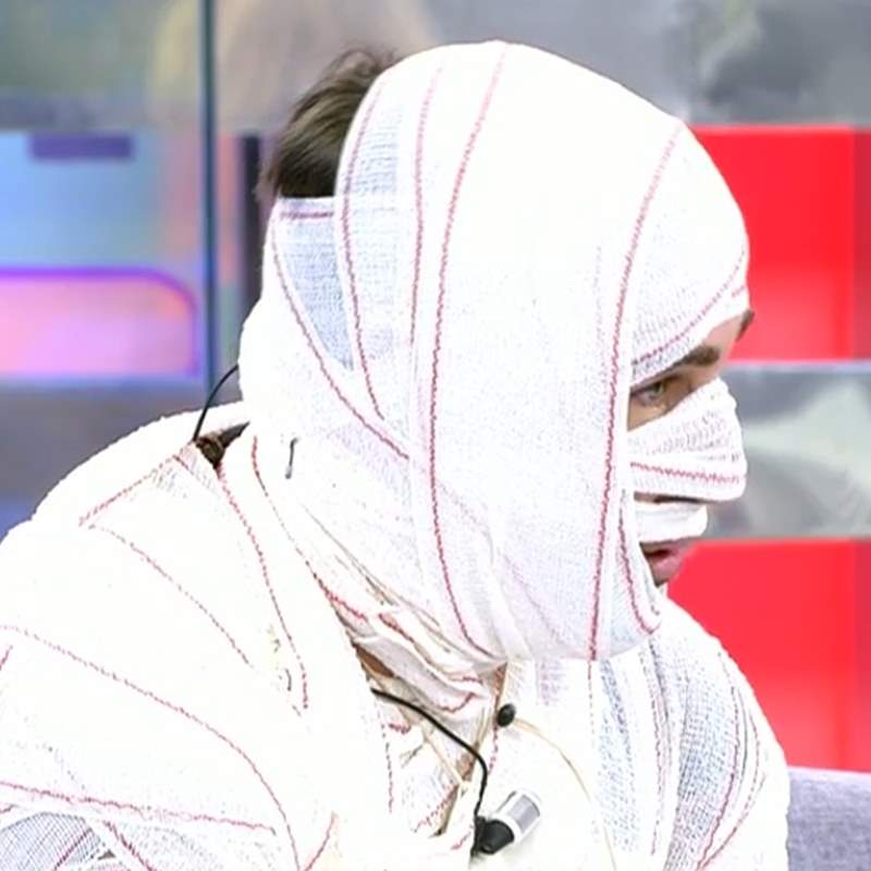 Rafa Mora, vendado como una momia, muestra el resultado de su último retoque estético en 'Sálvame'