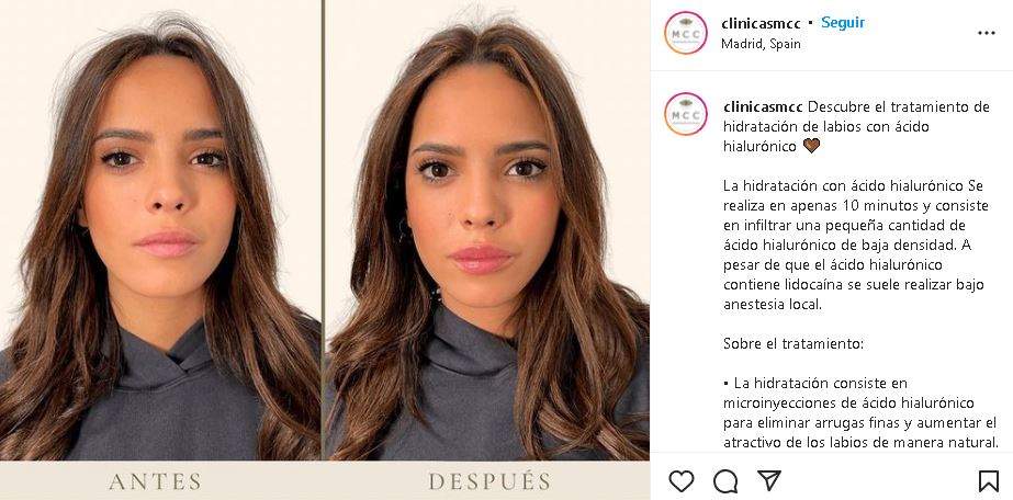 El antes y después de Gloria Camila tras su último retoque de labios