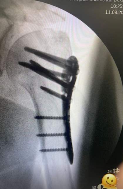 Radiografía del hombro de Mercedes Milá tras su operación