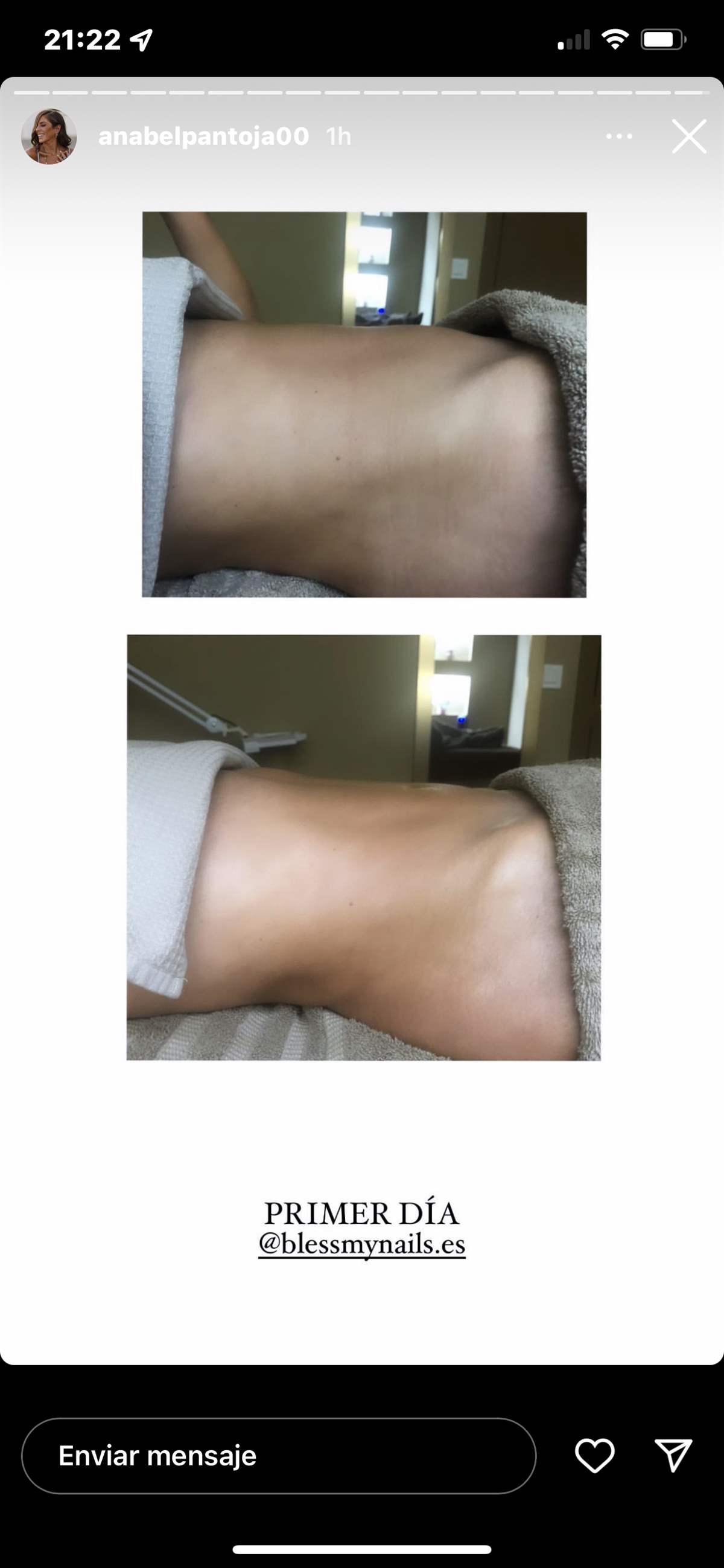 El antes y el después del abdomen de Anabel Pantoja